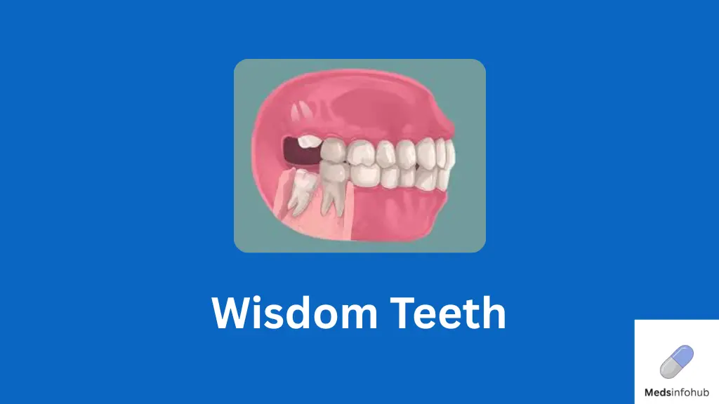 Wisdom Teeth